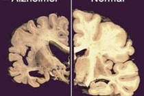 Alzheimer ile diyabet arasında bağlantı olabilir