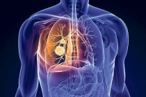 Akciğer kanseri, 5 yıl içinde ölümcül hastalık grubundan çıkacak