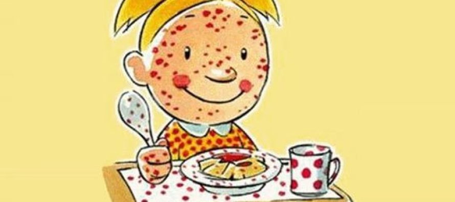 Besin alerjisi tanısı konulan çocuk için acil eylem planı yapılmalı
