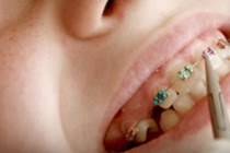 Çocuklar ortodontiste kaç yaşında gitmeli?